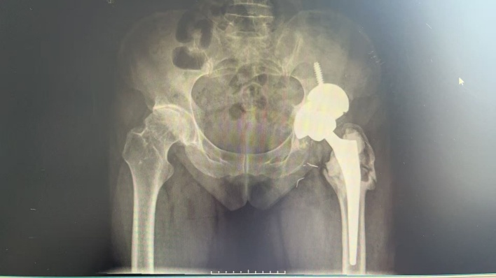 新余市人民医院骨一科成功完成全省首例VTS辅助人工髋关节翻修手术